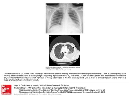 Miliary tuberculosis. (A) Frontal chest radiograph demonstrates innumerable tiny nodules distributed throughout both lungs. There is a hazy opacity at.