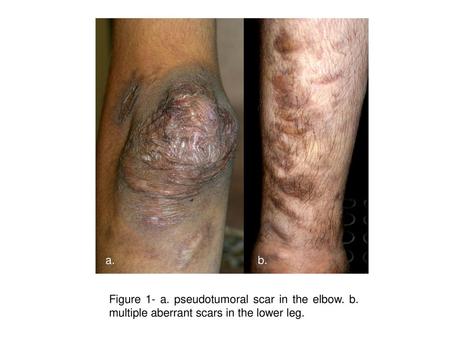 A. b. Figure 1- a. pseudotumoral scar in the elbow. b. multiple aberrant scars in the lower leg.