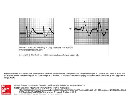 Electrocardiogram of a patient with hyperkalemia