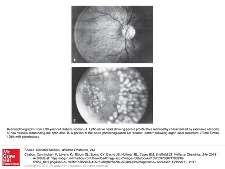 Retinal photographs from a 30-year-old diabetic woman. A