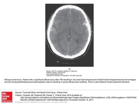 Diffuse axonal injury. Patient with a significant diffuse injury after TBI resulting in (A) small right temporal and medial frontal intraparenchymal hemorrhages.