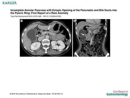 Incomplete Annular Pancreas with Ectopic Opening of the Pancreatic and Bile Ducts into the Pyloric Ring: First Report of a Rare Anomaly Case Rep Gastroenterol.