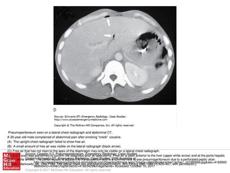 [C from: Markowitz SK, Ziter FHM: The lateral chest film and pneumoperitoneum. Ann Emerg Med 1986;15:425–427, with permission.] Source: Chapter II-3. Pneumoperitoneum,
