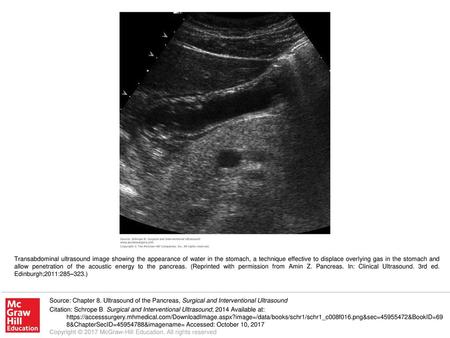 Transabdominal ultrasound image showing the appearance of water in the stomach, a technique effective to displace overlying gas in the stomach and allow.