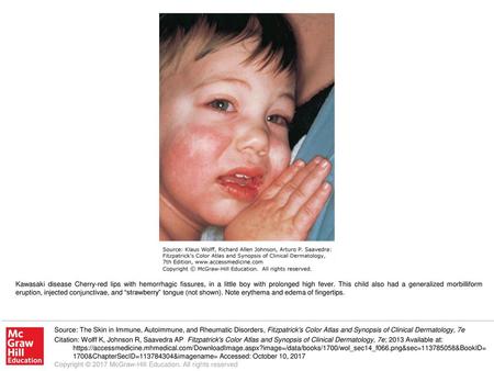Kawasaki disease Cherry-red lips with hemorrhagic fissures, in a little boy with prolonged high fever. This child also had a generalized morbilliform eruption,