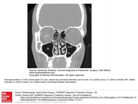 Sinonasal anatomy. In this coronal plane CT scan, several key sinonasal landmarks can be seen. M, maxillary sinus; IT, inferior turbinate; MT, middle turbinate;