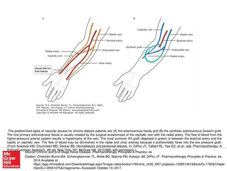 The predominant types of vascular access for chronic dialysis patients are (A) the arteriovenous fistula and (B) the synthetic arteriovenous forearm graft.