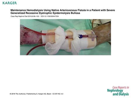 Maintenance Hemodialysis Using Native Arteriovenous Fistula in a Patient with Severe Generalized Recessive Dystrophic Epidermolysis Bullosa Case Rep Nephrol.