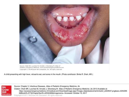 A child presenting with high fever, refusal to eat, and sores in the mouth. (Photo contributor: Binita R. Shah, MD.) Source: Chapter 3. Infectious Diseases,