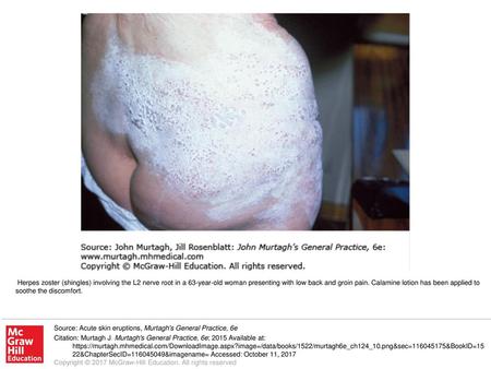 Herpes zoster (shingles) involving the L2 nerve root in a 63-year-old woman presenting with low back and groin pain. Calamine lotion has been applied to.