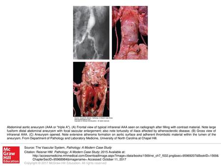 Abdominal aortic aneurysm (AAA or triple A)