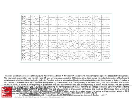 Transient Unilateral Attenuation of Background Activity During Sleep