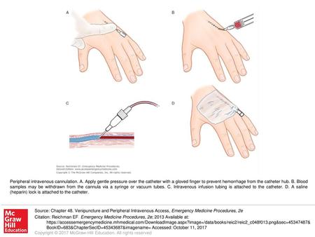 Peripheral intravenous cannulation. A