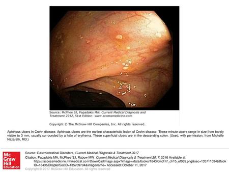 Aphthous ulcers in Crohn disease