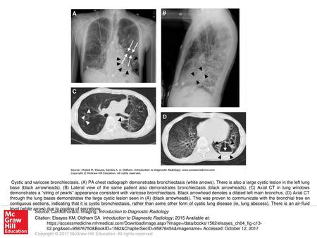 Cystic and varicose bronchiectasis