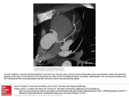 Curved multiplanar maximal intensity projection of the left main coronary artery and left anterior descending artery demonstrates calcific atherosclerotic.