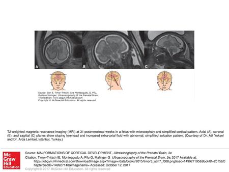 T2-weighted magnetic resonance imaging (MRI) at 31 postmenstrual weeks in a fetus with microcephaly and simplified cortical pattern. Axial (A), coronal.