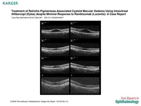 Treatment of Retinitis Pigmentosa-Associated Cystoid Macular Oedema Using Intravitreal Aflibercept (Eylea) despite Minimal Response to Ranibizumab (Lucentis):