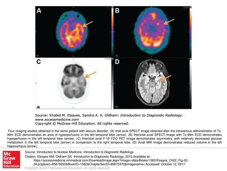 Four imaging studies obtained in the same patient with seizure disorder. (A) Ictal axial SPECT image obtained after the intravenous administration of Tc-99m.