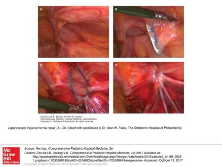 Laparoscopic inguinal hernia repair (A→D). (Used with permission of Dr