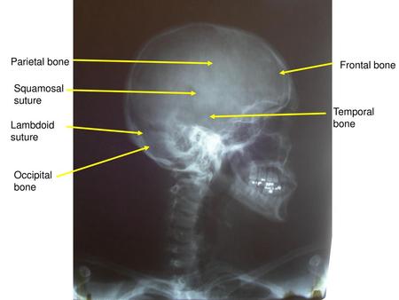 Parietal bone Frontal bone Squamosal suture Temporal bone