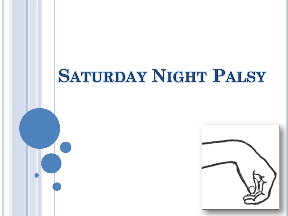 Saturday Night Palsy. - ppt video online download