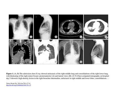 Figure 1. (A, B) The admission chest X-ray showed atelectasis of the right middle lung and consolidations of the right lower lung, with thickening of the.