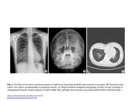 Fig. 1. (A) Chest X-ray shows increased opacity in right lower lung field, probably due to pectus excavatum. (B) Paranasal sinus waters view shows no abnormality.