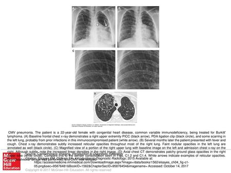 CMV pneumonia. The patient is a 22-year-old female with congenital heart disease, common variable immunodeficiency, being treated for Burkitt' lymphoma.