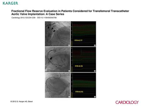 Fractional Flow Reserve Evaluation in Patients Considered for Transfemoral Transcatheter Aortic Valve Implantation: A Case Series Cardiology 2012;123:234–239.
