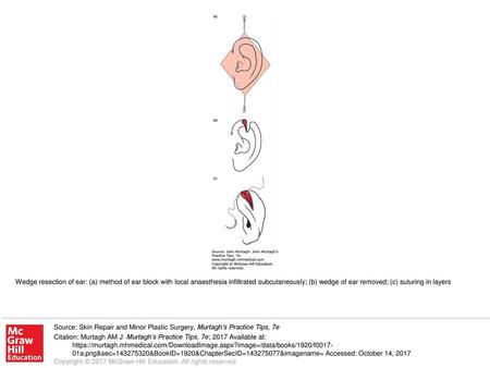 Wedge resection of ear: (a) method of ear block with local anaesthesia infiltrated subcutaneously; (b) wedge of ear removed; (c) suturing in layers Source: