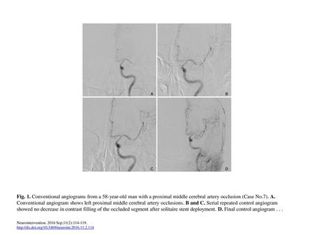 Fig. 1. Conventional angiograms from a 58-year-old man with a proximal middle cerebral artery occlusion (Case No.7). A. Conventional angiogram shows left.