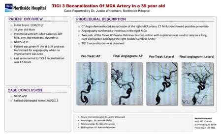 TICI 3 Recanalization Of MCA Artery in a 39 year old