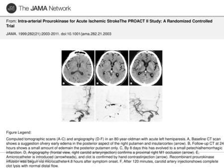 From: Intra-arterial Prourokinase for Acute Ischemic StrokeThe PROACT II Study: A Randomized Controlled Trial JAMA. 1999;282(21):2003-2011. doi:10.1001/jama.282.21.2003.