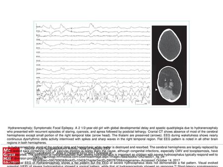 The typical EEG of hydranencephaly shows a flat pattern but the EEG of severe hydrocephalus does not demonstrate a flat pattern. Visual evoked potential.