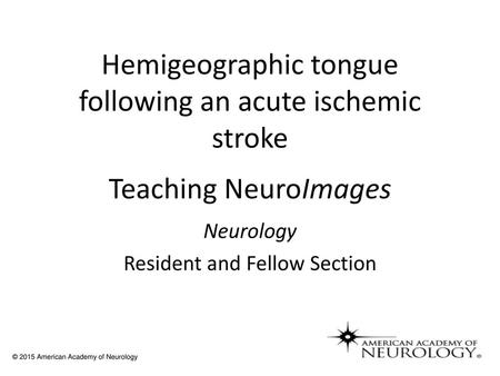 Hemigeographic tongue following an acute ischemic stroke