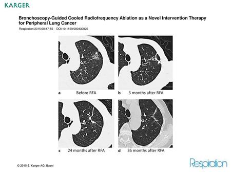 Bronchoscopy-Guided Cooled Radiofrequency Ablation as a Novel Intervention Therapy for Peripheral Lung Cancer Respiration 2015;90:47-55 - DOI:10.1159/000430825.