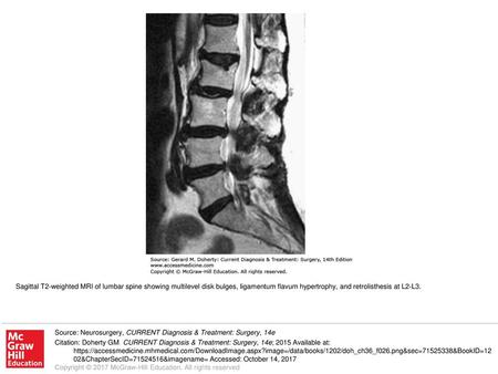 Sagittal T2-weighted MRI of lumbar spine showing multilevel disk bulges, ligamentum flavum hypertrophy, and retrolisthesis at L2-L3. Source: Neurosurgery,