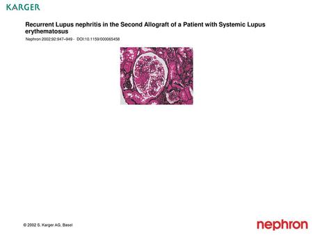 Recurrent Lupus nephritis in the Second Allograft of a Patient with Systemic Lupus erythematosus Nephron 2002;92:947–949 - DOI:10.1159/000065458 Fig.