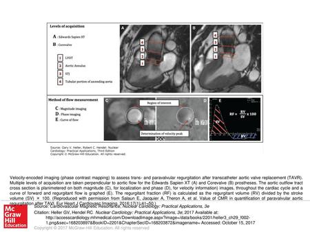Velocity-encoded imaging (phase contrast mapping) to assess trans- and paravalvular regurgitation after transcatheter aortic valve replacement (TAVR).