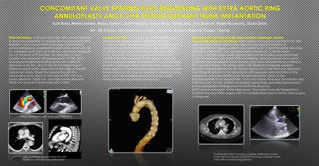 Concomitant valve sparing root remodeling with extra aortic ring annuloplasty and e-vita stented elephant trunk implantation Igor Rudez, Marko Kusurin,