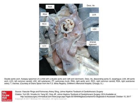 Double aortic arch. Autopsy specimen of a child with a double aortic arch (left arch dominant). Desc. Ao, descending aorta; E, esophagus; LAA, left aortic.