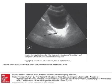 Acoustic enhancement increasing the signal off the posterior wall of the bladder (black arrow). Source: Chapter 2. Ultrasound Basics, Handbook of Critical.