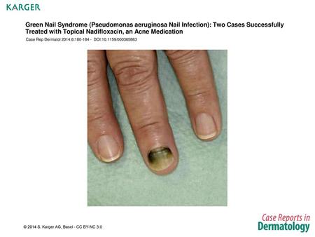 Green Nail Syndrome (Pseudomonas aeruginosa Nail Infection): Two Cases Successfully Treated with Topical Nadifloxacin, an Acne Medication Case Rep Dermatol.
