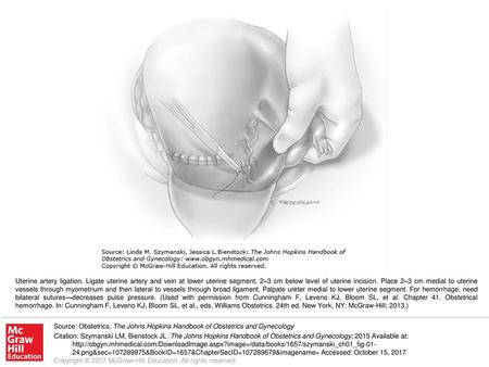 Uterine artery ligation