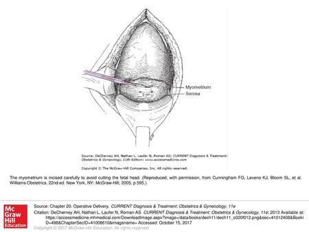 The myometrium is incised carefully to avoid cutting the fetal head