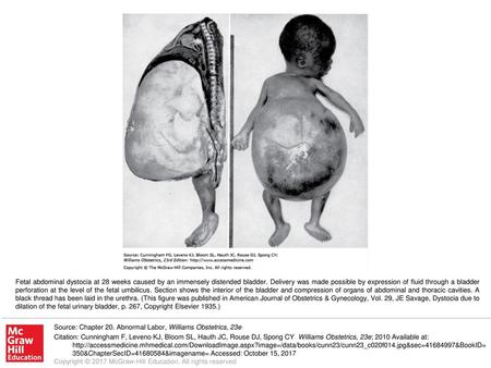 Fetal abdominal dystocia at 28 weeks caused by an immensely distended bladder. Delivery was made possible by expression of fluid through a bladder perforation.