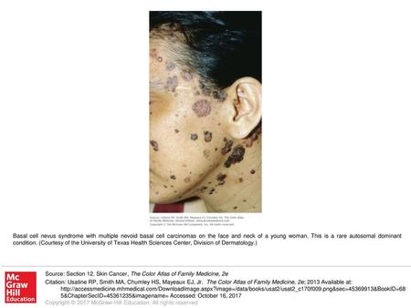 Basal cell nevus syndrome with multiple nevoid basal cell carcinomas on the face and neck of a young woman. This is a rare autosomal dominant condition.