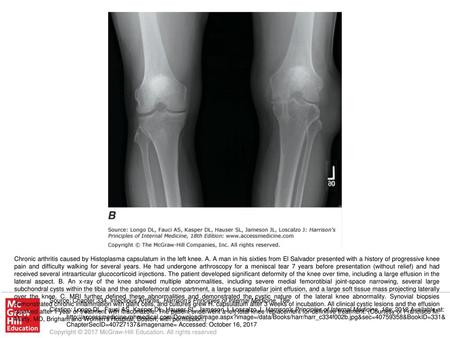 Chronic arthritis caused by Histoplasma capsulatum in the left knee. A