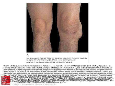 Chronic arthritis caused by Histoplasma capsulatum in the left knee. A